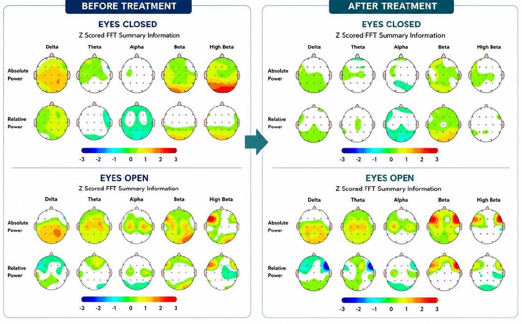 Before and after qEEG brain map for this client