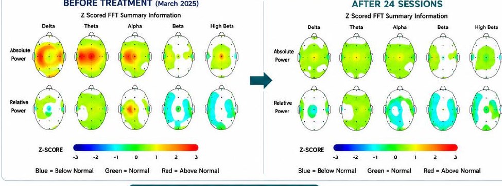 Before and after qEEG brain map for this client