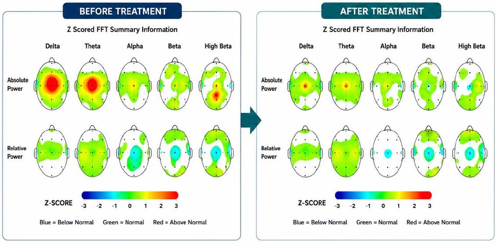 Before and after qEEG brain map for this client